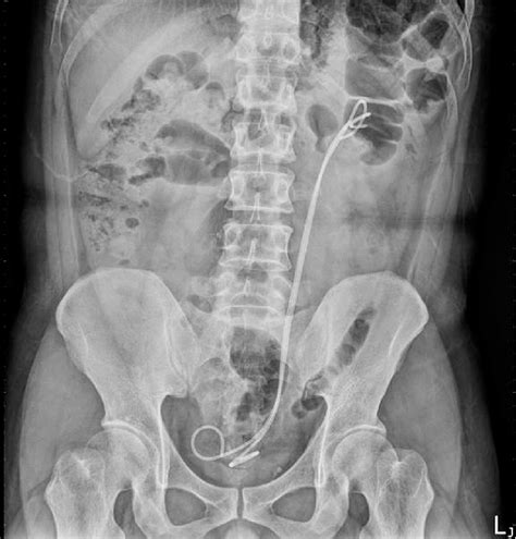 Plain Kidney Ureter And Bladder Radiograph Shows Two Double J Stents
