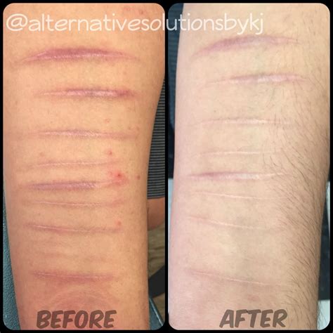 Color Tattoo Removal Before And After Colorxml