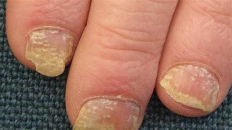 Eczema Fingernails