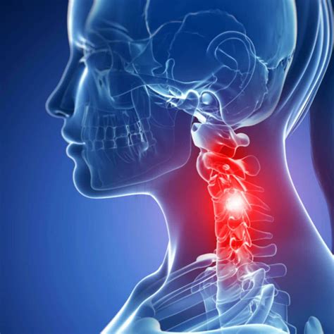 Pinched Nerve In Neck Trapped Compressed Nerve Treatment