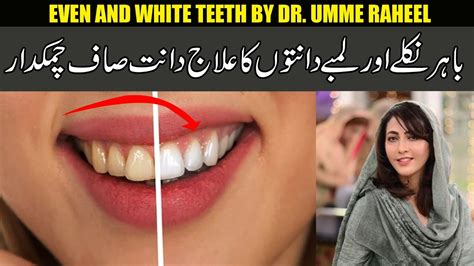 Uneven Long Teeth And Teeth Whitening By Dr Umme Raheel Youtube
