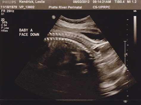 Two Babies 280 Days One Womb 31 Week Ultrasound