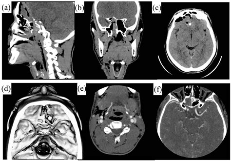 Skull Base Penetration Due To Cervical Impalement Injury A Case Report