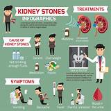 Kidney stones are hard masses that form in the kidneys when there is not enough liquid to dilute waste chemicals in the urine. Male Signs of Kidney Stones | STD.GOV Blog
