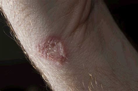 Ringworm Fungal Infection Causes Symptoms And Treatment Treating Fungus