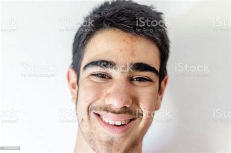 Teenage Boy With Acne Problem On White Background Stock Photo