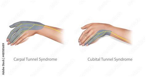 Medical Illustration Of The Cubital And Carpal Tunnel Syndrome