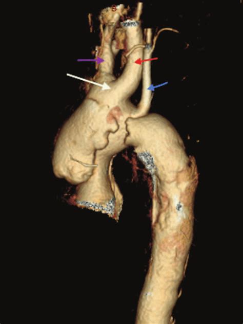 Ct Scan Image Volume Rendered Bovine Arch And Aortic Stanford B