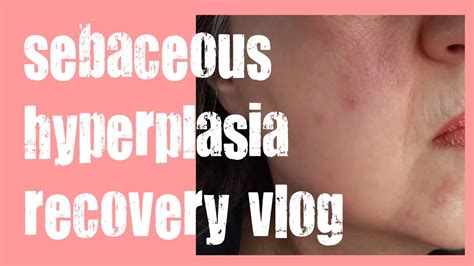 Removing My Sebaceous Hyperplasia Skin Classic Treatment And Recovery