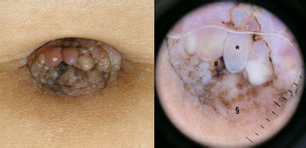 Here's everything you need to know about symptoms, cause, diagnosis and treatment. Umbilical cutaneous endometriosis: clinical presentation ...