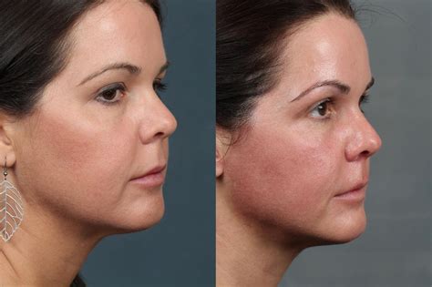 Ultherapy Before And After Photos Patient 704 Louisville Ky Calospa
