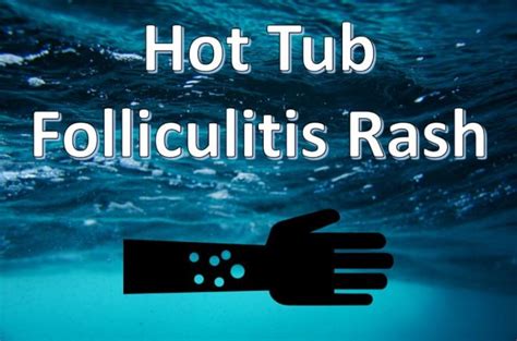 Hot Tub Rash Causes Symptoms Prevention And Treatment