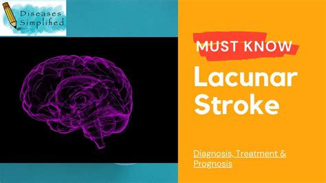 Must Know Lacunar Stroke Youtube