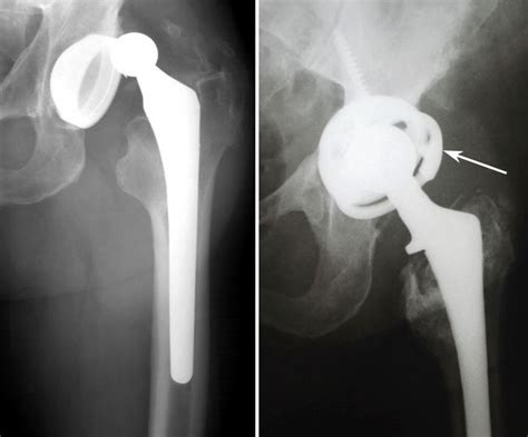 Revision Total Hip Replacement Orthoinfo Aaos