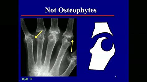 Imaging In Osteoarthritis Youtube