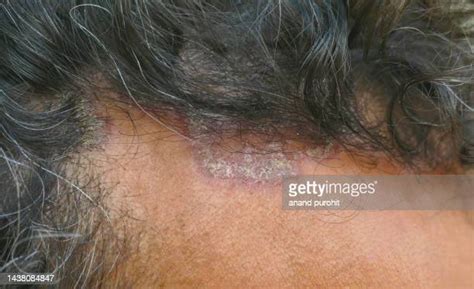 Seborrheic Dermatitis Hair Photos And Premium High Res Pictures Getty