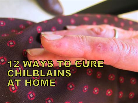12 Simple Chilblain Treatments Natural And Homemade