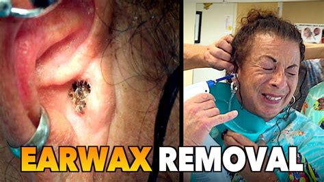 Massive Earwax Removal Dr Paul Feat Maiya My Wife Youtube