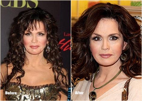 Pics Photos Marie Osmond Plastic Surgery Before And After Photos Pics