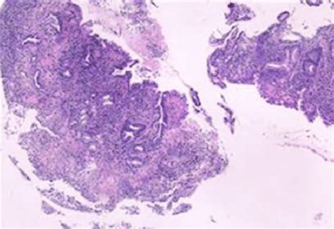 The Pathology From The Esophageal Lesion Of The Reported Case