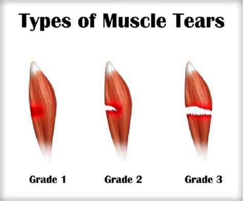 What Are The Symptoms And Treatment Of Torn Muscle Miracle Rehab Clinic