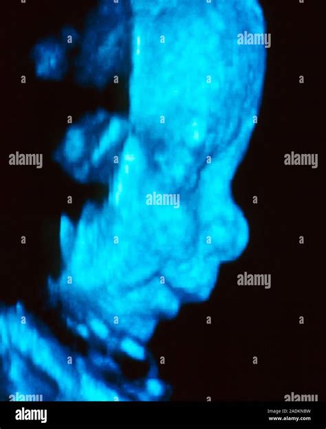 3 D Foetal Ultrasound Coloured Three Dimensional 3 D Ultrasound Scan