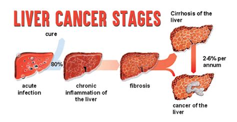 Others test out new doses, combinations of medications, or uses for existing prescription. Liver Cancer Stages- How Stages of Lung Cancer are Determined!