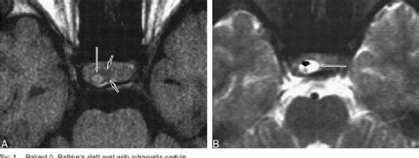 Pdf Mr Imaging Findings Of Rathkes Cleft Cysts Significance Of