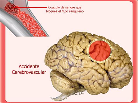 The cells of the nervous system, neurons, need a constant supply of oxygen and. ACCIDENTE CEREBRO VASCULAR: Introducción Accidentes ...