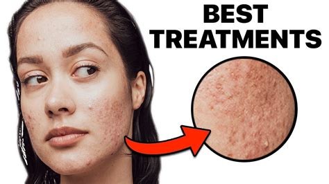How To Get Rid Of Acne Scars Youtube