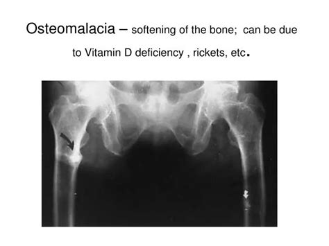 Ppt Osteomalacia Softening Of The Bone Can Be Due To Vitamin D