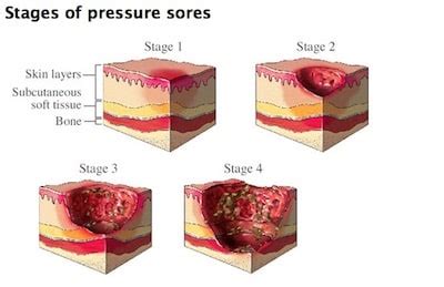 What Are The Stages Of Bed Sores Nursing Home Law Center LLC