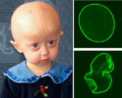 Progeriacausessymptomsdiagnosisand More Interviewgig