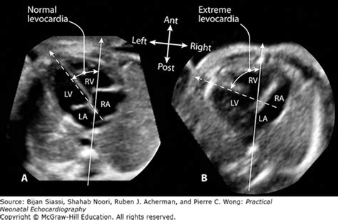 Overview Of Fetal Echocardiography Thoracic Key