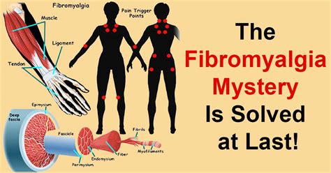 It's often associated with widespread pain, cognitive issues, and fatigue. Groundbreaking Discovery Which Could Change the Treatment ...