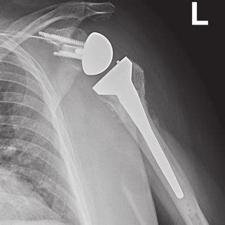 —A 4-part proximal humerus fracture (A) managed with a ...