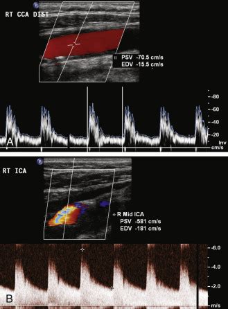 Ultrasound Assessment Of Carotid Stenosis Radiology Key