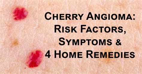 Cherry Angioma Risk Factors Symptoms And 4 Home Remedies David