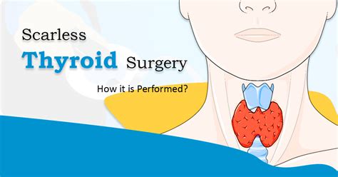 Endoscopic Thyroidectomy Scarless Thyroid Surgery