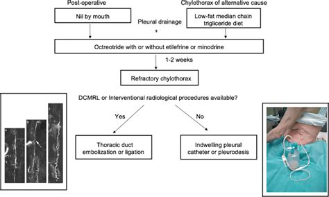 Treatment Algorithm For Chylothorax Thoracic Duct Photos Reproduced