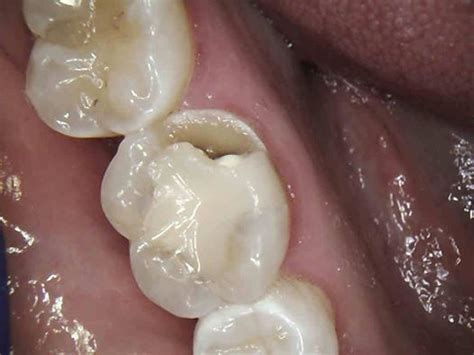 With insurance, the expense of dental crowns can be around $900. Can my tooth be restored with a filling versus a dental crown? - Your Dental Health Resource