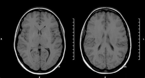 Idiopathic Intracranial Hypertension Doc Bobby Jones Csf