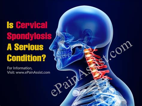 Is Cervical Spondylosis A Serious Condition How Can It Be Treated