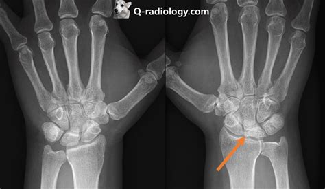 Kienbocks Disease Radiology Osteonecrosis Of Lunate Bone Q Radiology