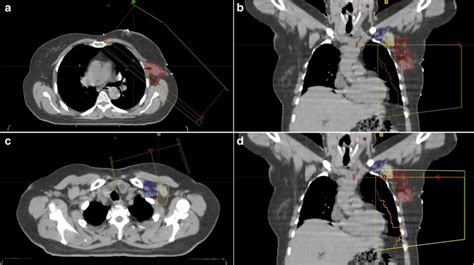 Coverage Of Axillary Lymph Nodes With Different Breast Radiation
