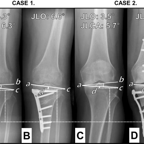 Radiographs Showing Pre And Post Operative Joint Line Obliquity Jlo