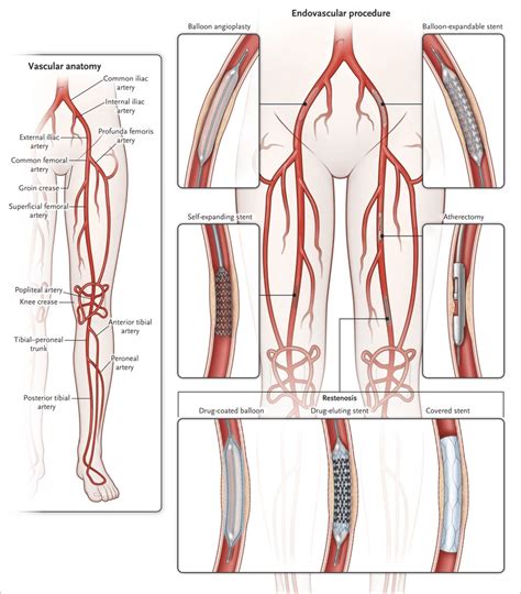 Posterior Tibial Artery Angiogram