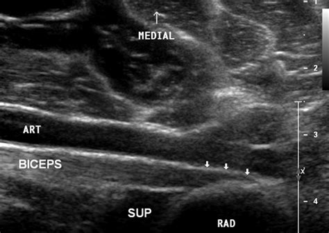 Distal Biceps Tendon Ultrasound