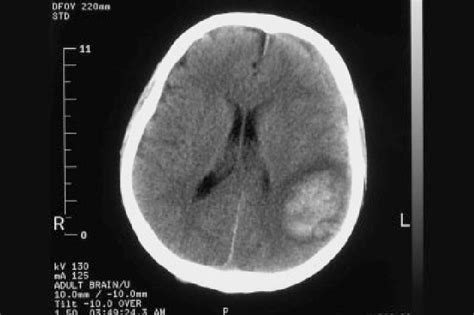Ct Scan Of The Brain Large Intracerebral Hematoma In The Left Parietal