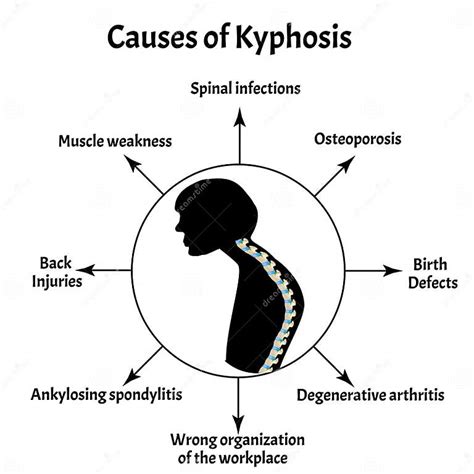 Causes Of Kyphosis Spinal Curvature Kyphosis Lordosis Scoliosis